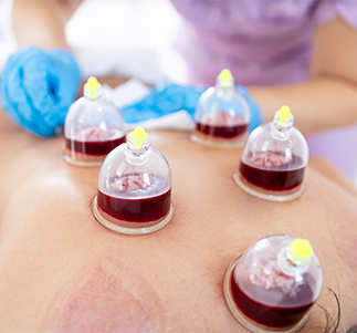Wet Cupping (Hijama)